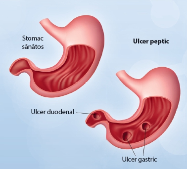 ulcerul duodenal provoacă pierderea în greutate