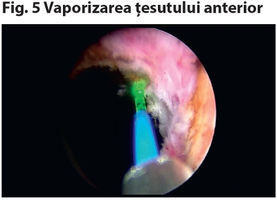 Vaporizarea laser verde a adenomului de prostata | Prostaffect În România