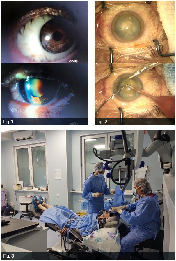 Se schimbă acuitatea vizuală în perioada postoperatorie a cataractei