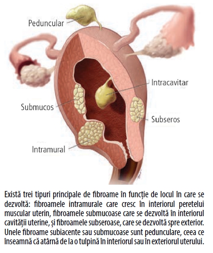 Fibrom Uterin: Simptome, Cauze, Diagnostic & Tratament